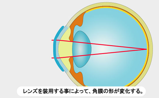 レンズを装着する事によって、角膜の形が変化する