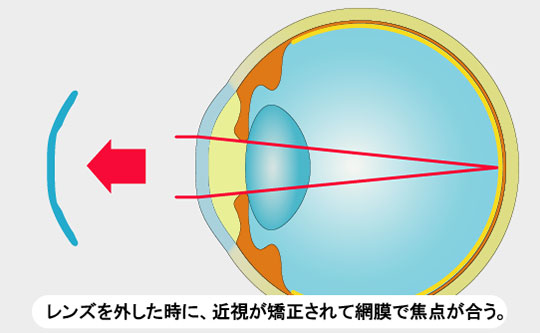 レンズを外した時に、近視が矯正されて網膜で焦点が合う